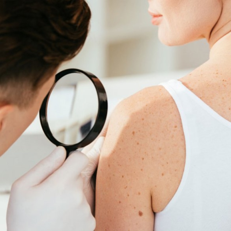 الشامات يمكن أن تتحول إلى سرطان في الجلد