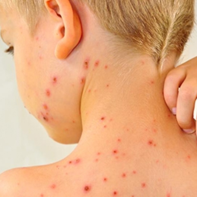 اعراض الحصبة الالمانية عند الاطفال وطرق علاجها