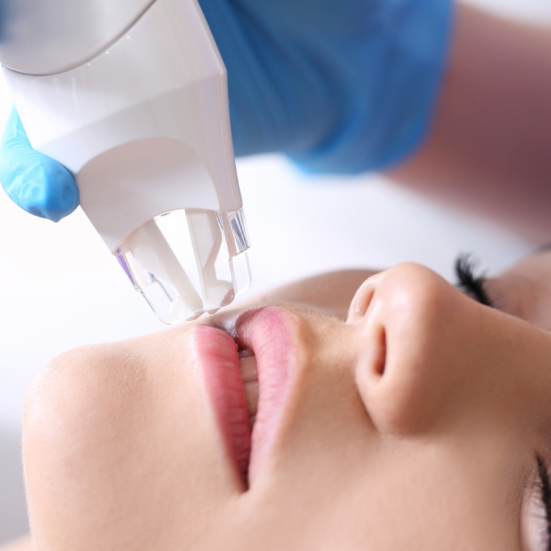 أصبح الليزر الحل الأكثر اعتماداً من قبل النساء والأطباء لتصغير الشفايف