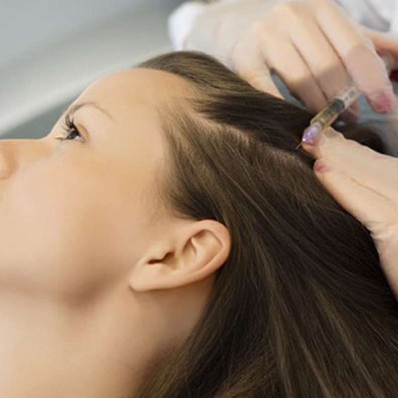 حقن البلازما الغنية بالصفائح الدموية قد تساعد في تقليل تساقط الشعر 