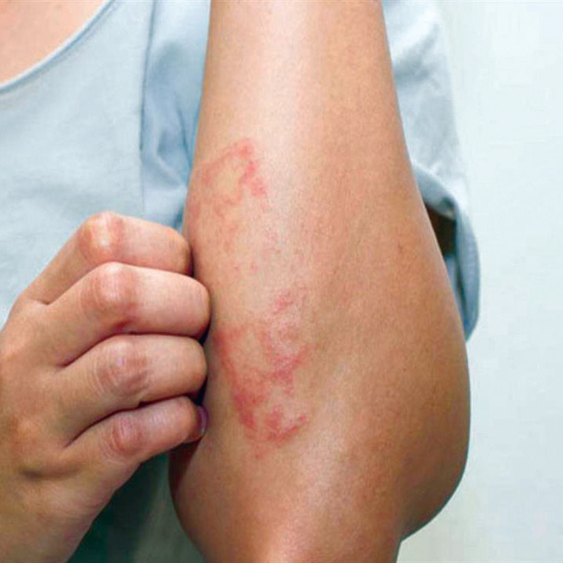  التقران السعفي يسبب بقع خشنة على الجلد