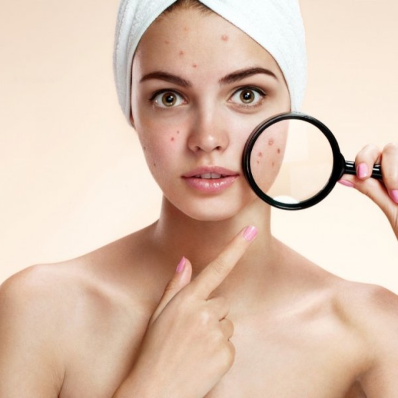 تخلصي من حب الشباب بالطرق الطبيعية في رمضان