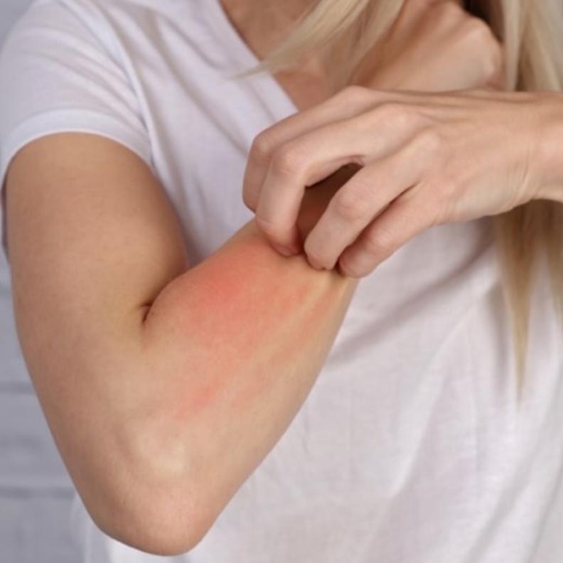 التسمم الشمسي يسبب التهيج و الألم