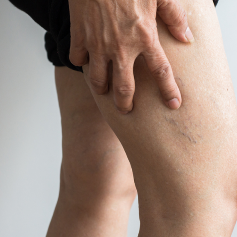 ماهو التخثر الوريدي العميق في الساق وما أسبابه