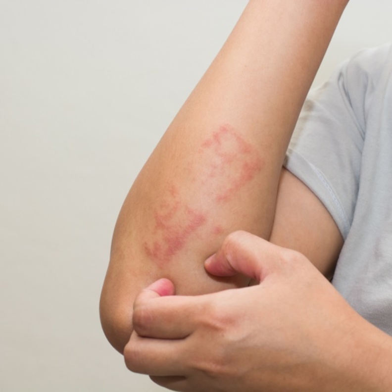  ماهي أعراض التهاب الجلد التماسي