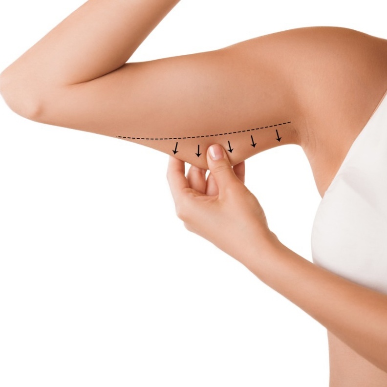 عملية نحت الجسم وشفط الدهون بالفيزر هو إجراء منخفض الخطورة