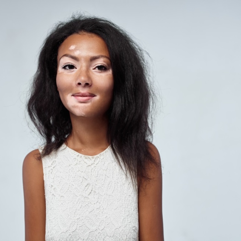 هل مرض البهاق معدي ام لا