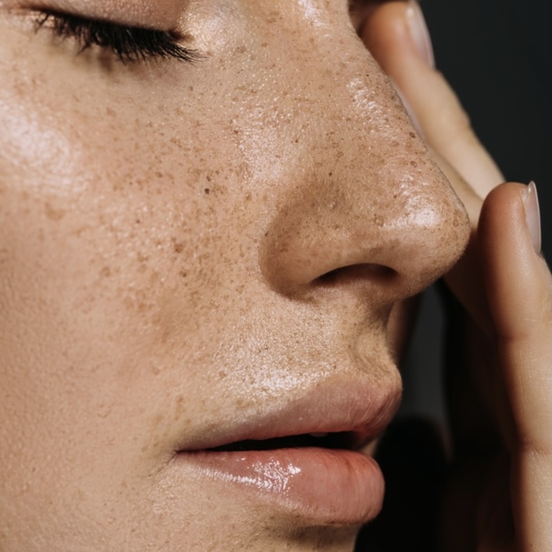  إزالة الكلف والنمش بالماسكات الطبيعية