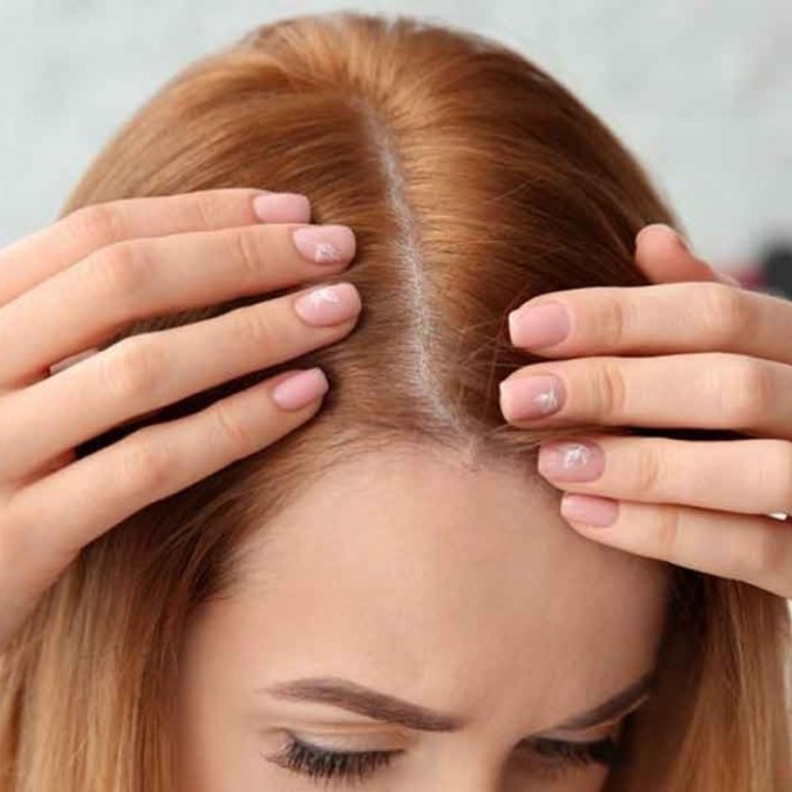 زراعة الشعر هو إجراء يتم فيه نقل الشعر إلى منطقة أصلع من الرأس لتكثيفها