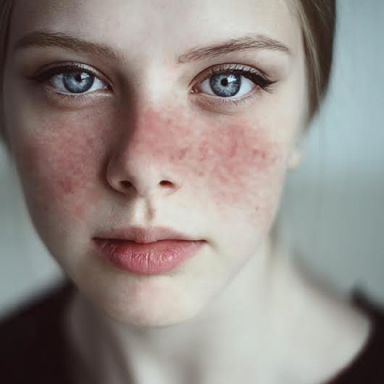  الذئبة الحمراء مرض مناعي يصيب النساء أكثر من الرجال