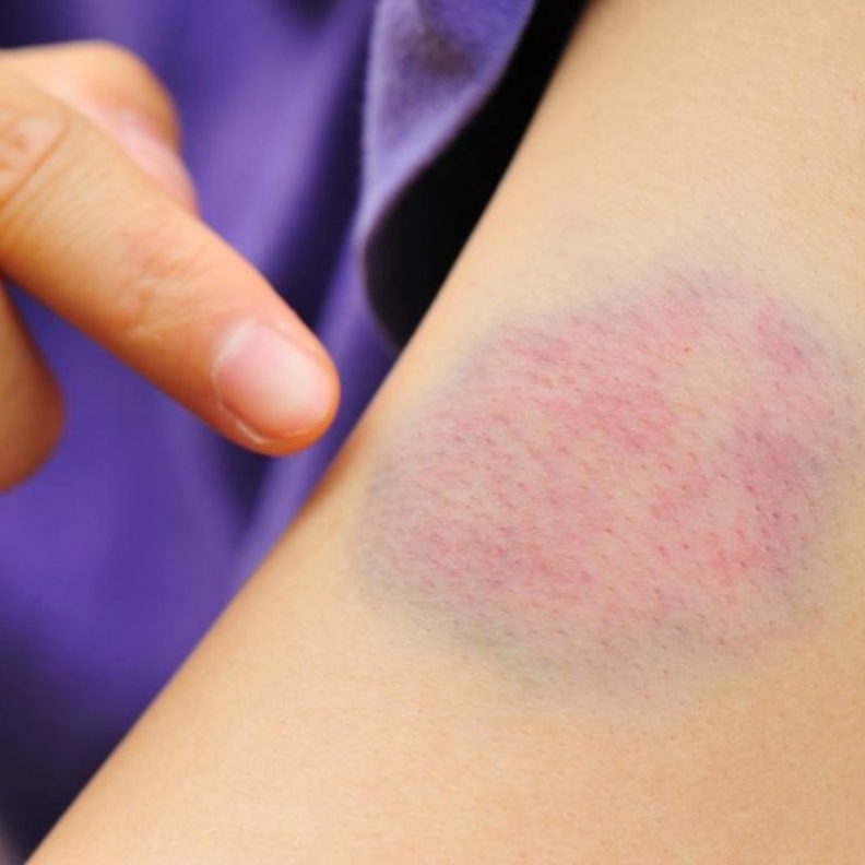 طرق الوقاية من الجلطة الدموية