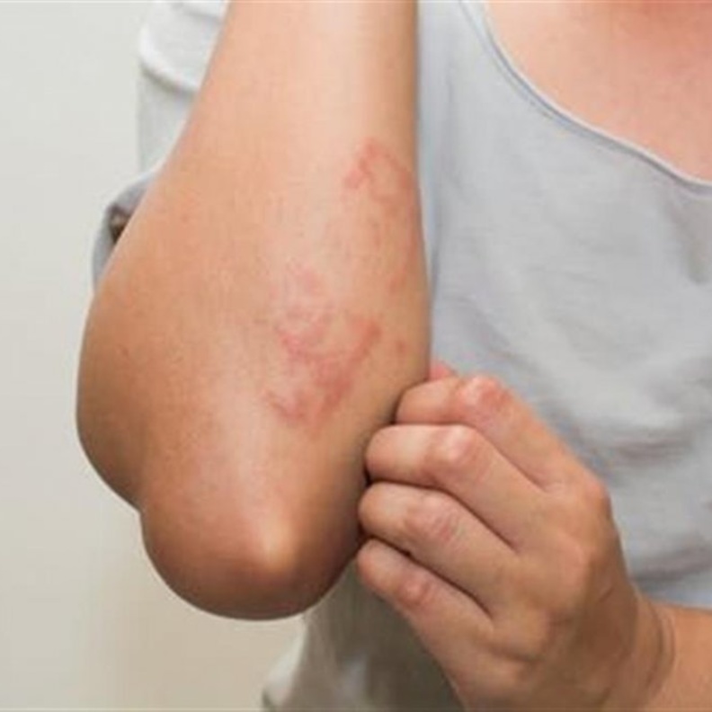 هل من الممكن ان يكون الطفح الجلدي من علامات الإصابة بفيروس كورونا