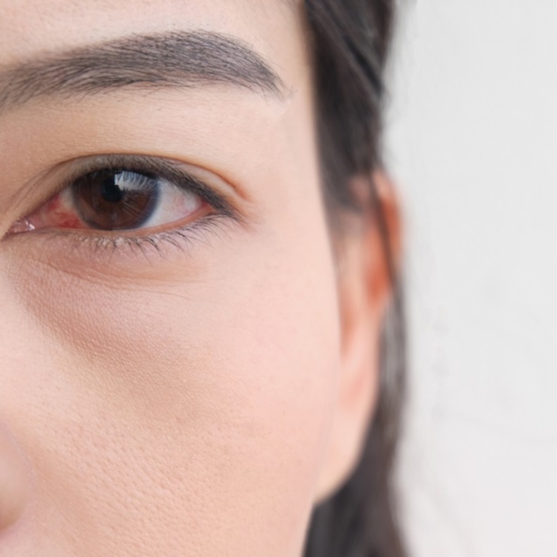 كيف يمكن تشخيص جلطة العين وما هي مضاعفاتها