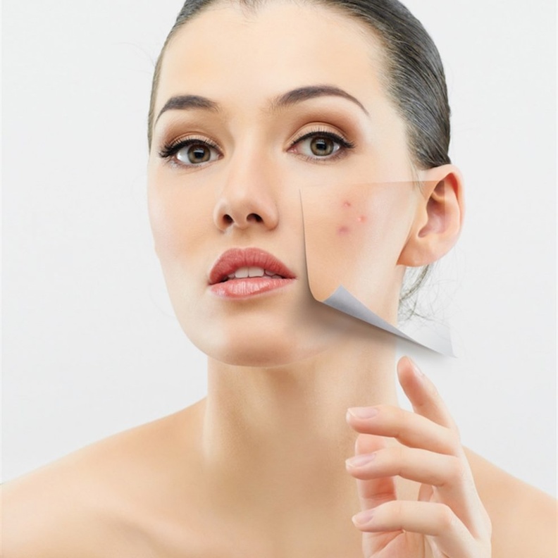طرق التخلص وعلاج ندبات حب الشباب تجميلياً