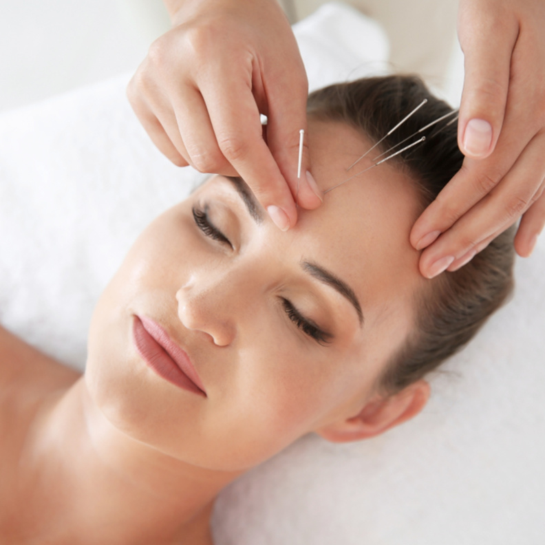 الإبر الصينية تساعد على تقليل التوتر