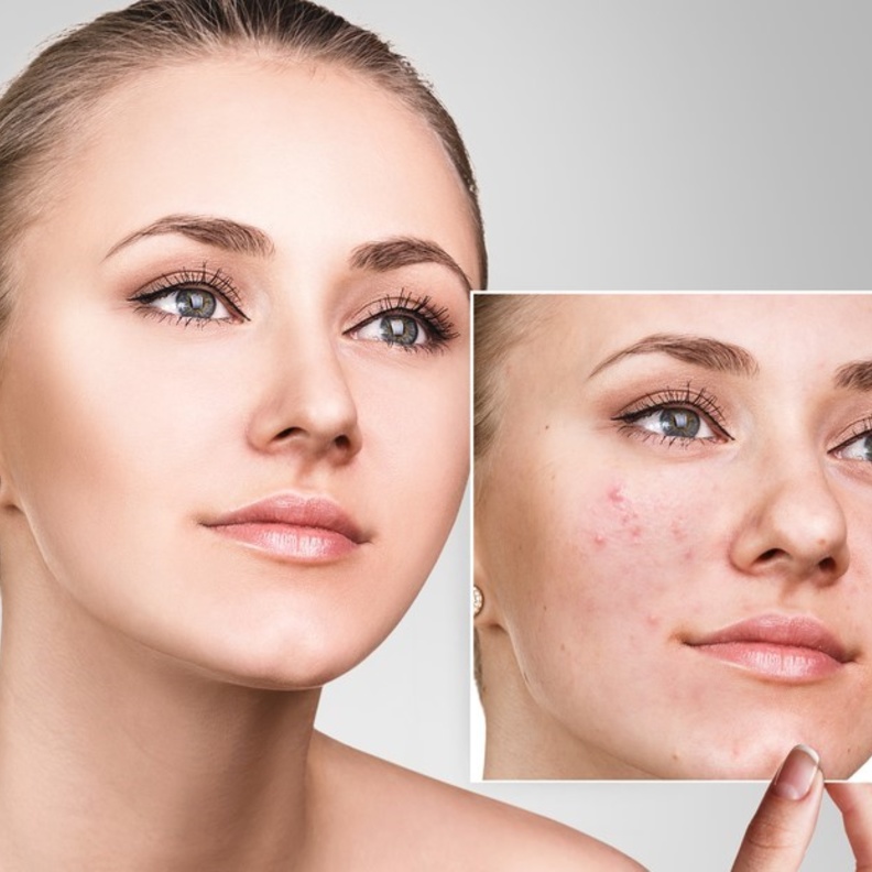 نصائح جمالية عند استخدام ماسك القرفة واللبن للتخلص من حب الشباب