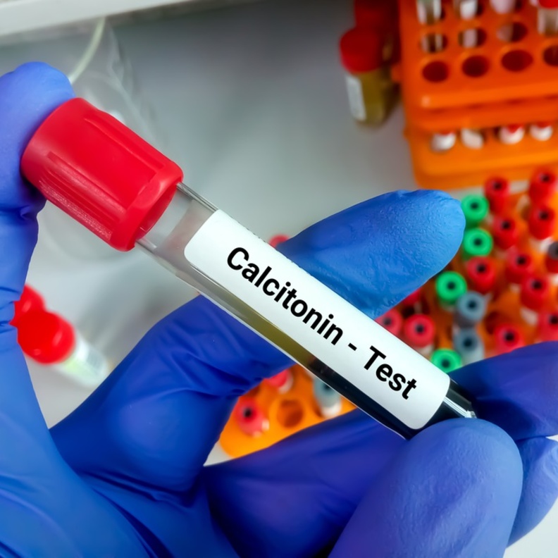  ما هو هرمون الكالسيتونين وما هي الاسباب المرضية وراء الزيادة في افرازه