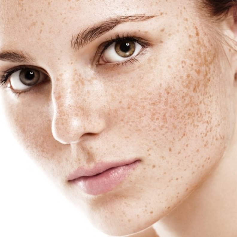  نصائح جمالية لعلاج النمش في الوجه