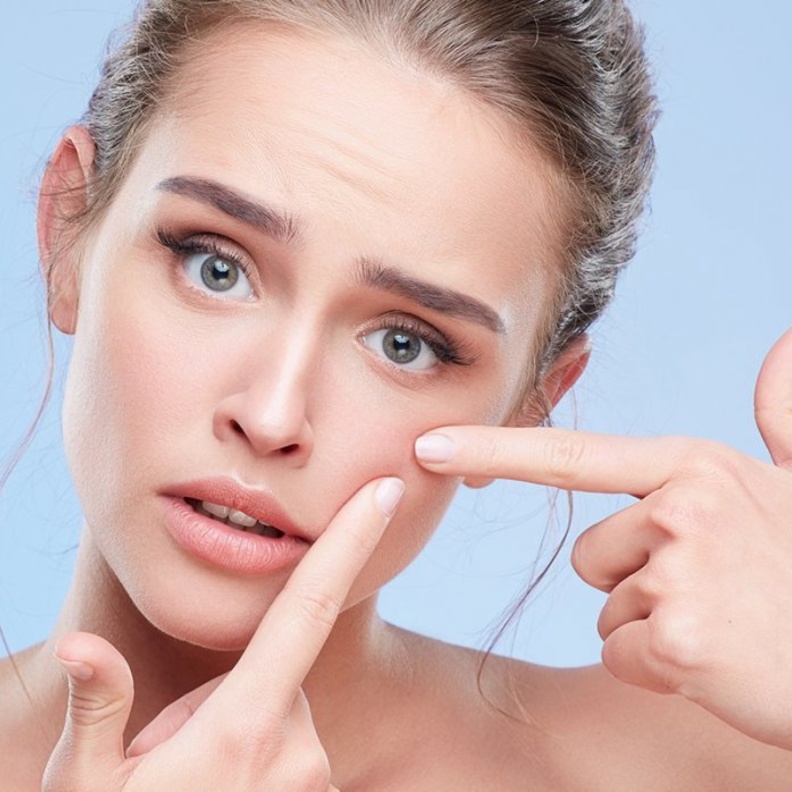 البثور مشكلة لا بد من حلها بسرعة قبل الزفاف