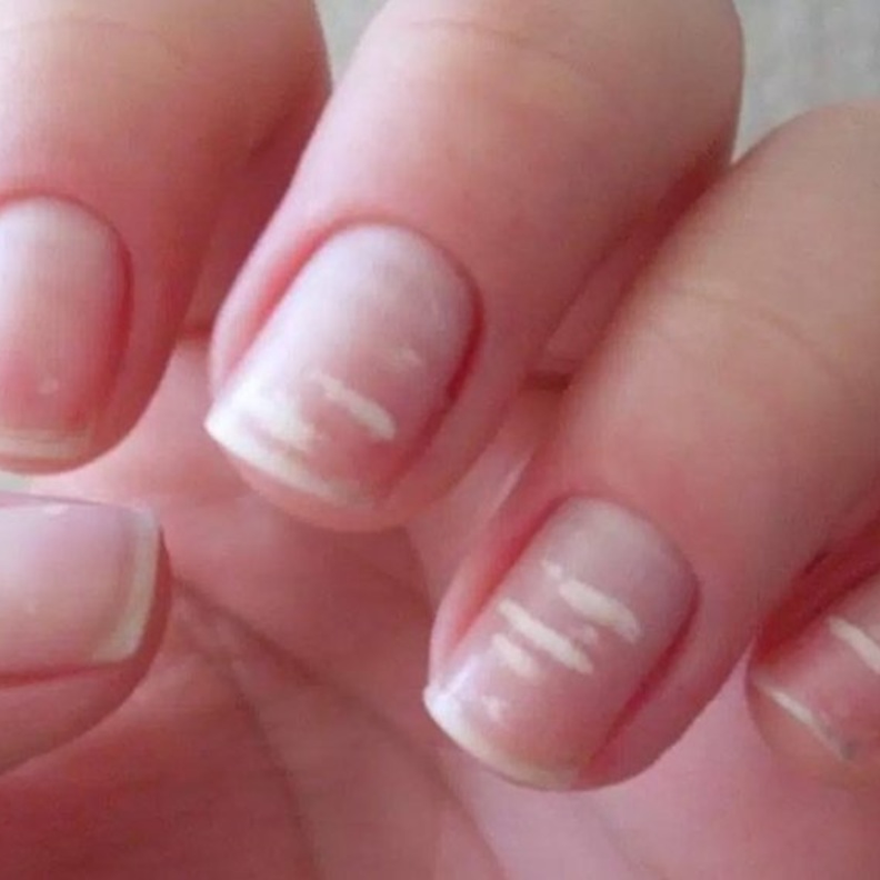 الخطوط البيضاء على الاظافر من اعراض كورونا