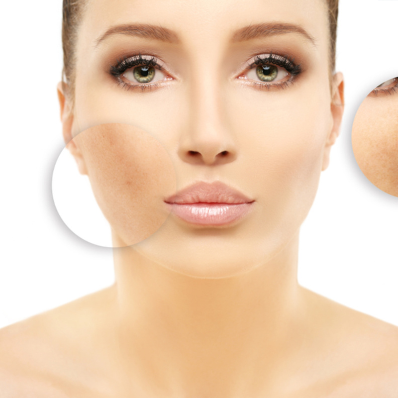  اضرار علاج التصبغات الجلدية بالليزر