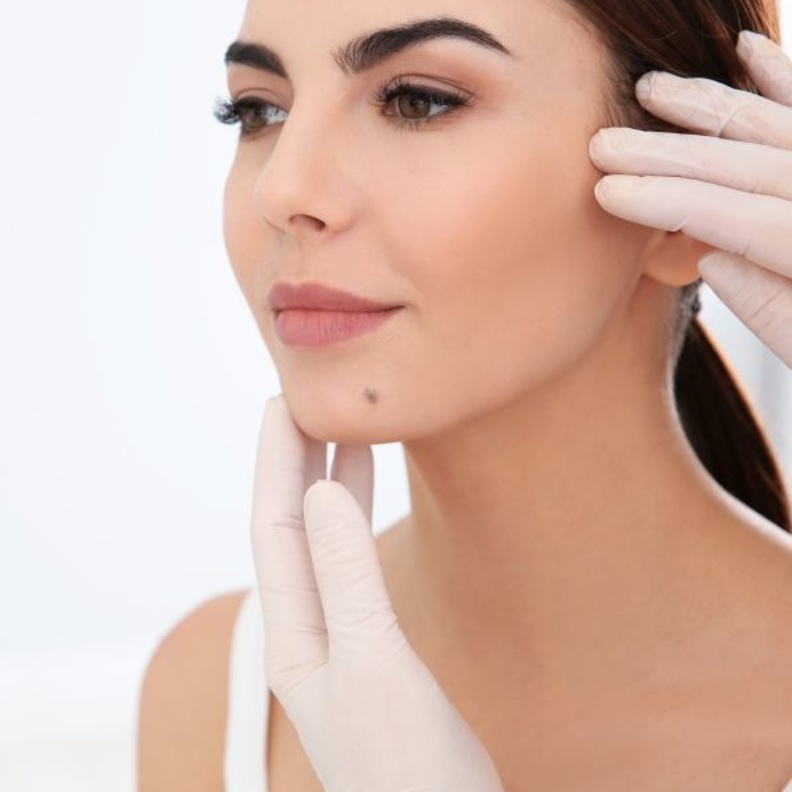 إزالة الشامات بالليزر تعد الطريقة الأسهل والأكثر استخداماً بين النساء