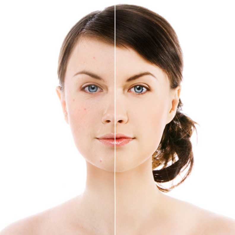 هل يتوقف ظهور حب الشباب عند التوقف عن استهلاك مشتقات الألبان؟