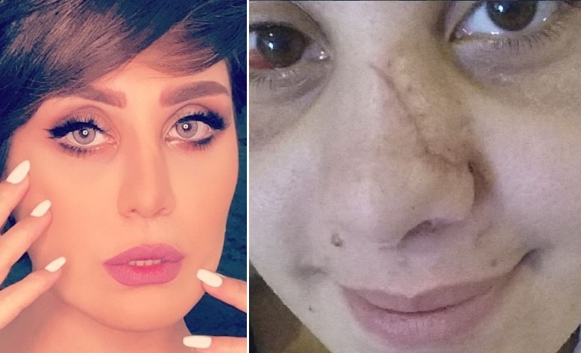 الفنانة شوق اضطرت الى الخضوع لعمليات التجميل في انفها