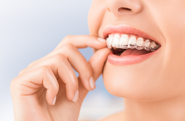 الانفزلاين يعالج مشاكل الأسنان الملتوية ويمنحك ابتسامة رائعة