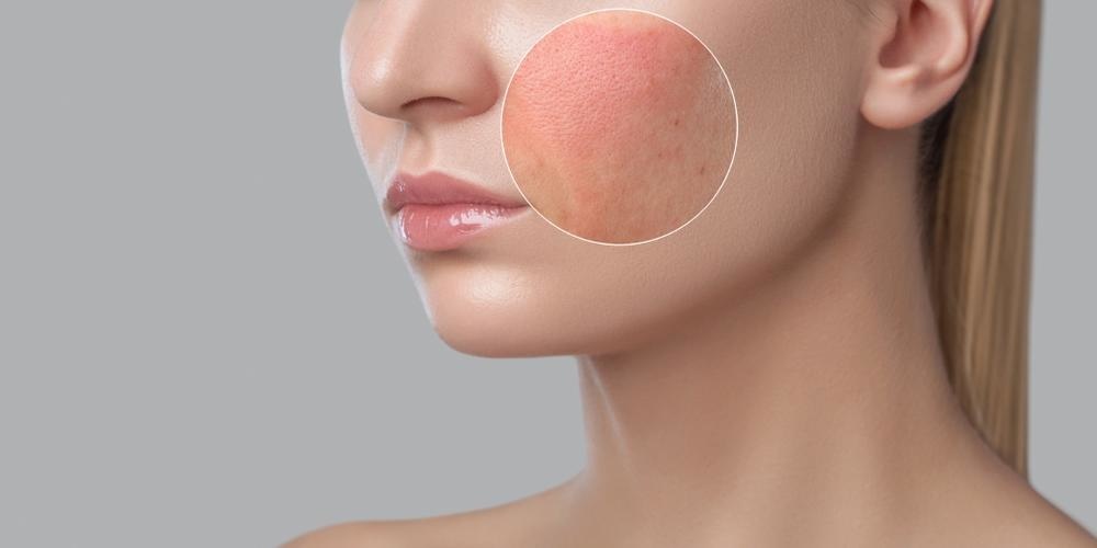 طرق التخلص من آثار الحروق تجميلياً وأهم الأنواع والنتائج 