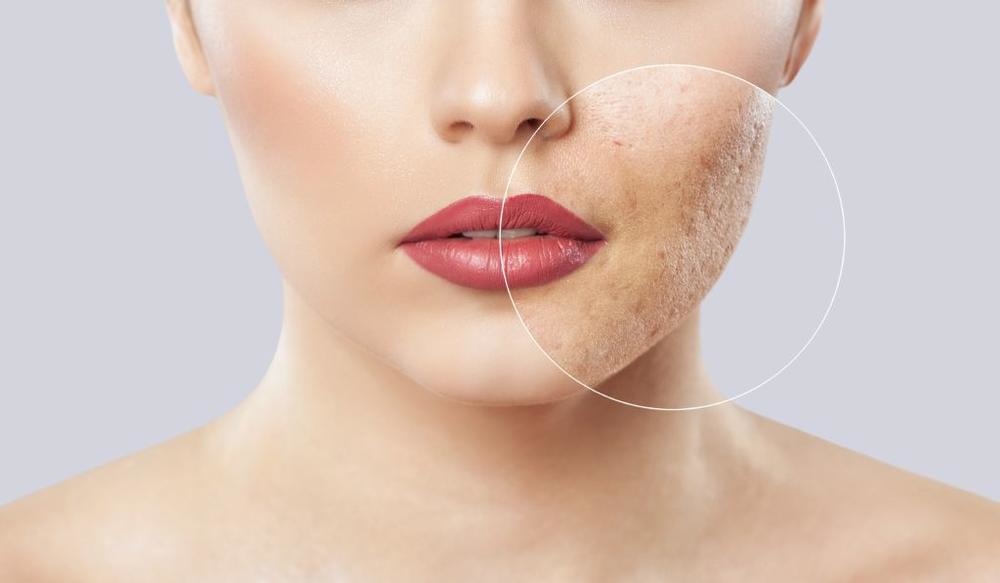 طرق غير جراحية للتخلص من ندبات الوجه